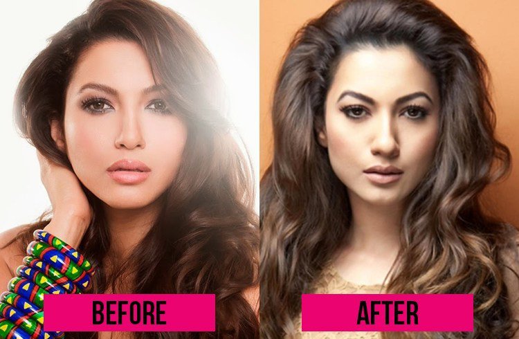 gauhar-khan-before-and-after-surgery