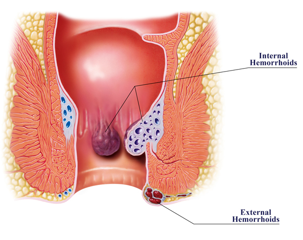 Types of Piles or Hemorrhoids